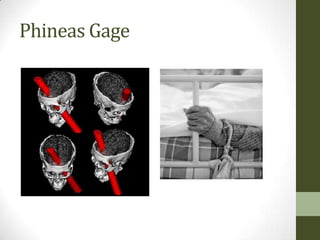Phineas Gage
 