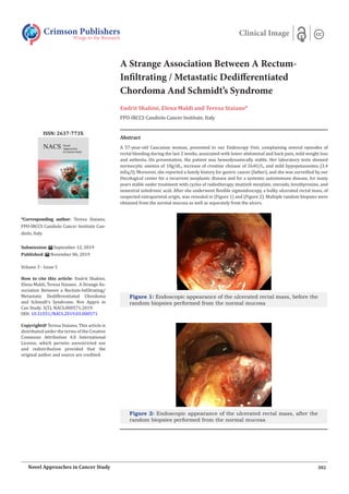 A Strange Association Between A Rectum-
Infiltrating / Metastatic Dedifferentiated
Chordoma And Schmidt’s Syndrome
Endrit Shahini, Elena Maldi and Teresa Staiano*
FPO-IRCCS Candiolo Cancer Institute, Italy
Crimson Publishers
Wings to the Research
Clinical Image
*Corresponding author: Teresa Staiano,
FPO-IRCCS Candiolo Cancer Institute Can-
diolo, Italy
Submission: September 12, 2019
Published: November 06, 2019
Volume 3 - Issue 5
How to cite this article: Endrit Shahini,
Elena Maldi, Teresa Staiano. A Strange As-
sociation Between a Rectum-Infiltrating/
Metastatic Dedifferentiated Chordoma
and Schmidt’s Syndrome. Nov Appro in
Can Study. 3(5). NACS.000571.2019.
DOI: 10.31031/NACS.2019.03.000571
Copyright@ Teresa Staiano, This article is
distributed under the terms of the Creative
Commons Attribution 4.0 International
License, which permits unrestricted use
and redistribution provided that the
original author and source are credited.
ISSN: 2637-773X
302
Novel Approaches in Cancer Study
Abstract
A 57-year-old Caucasian woman, presented to our Endoscopy Unit, complaining several episodes of
rectal bleeding during the last 2 weeks, associated with lower abdominal and back pain, mild weight loss
and asthenia. On presentation, the patient was hemodynamically stable. Her laboratory tests showed
normocytic anemia of 10g/dL, increase of creatine chinase of 264U/L, and mild hypopotassemia (3.4
mEq/l). Moreover, she reported a family history for gastric cancer (father), and she was surveilled by our
Oncological center for a recurrent neoplastic disease and for a systemic autoimmune disease, for many
years stable under treatment with cycles of radiotherapy, imatinib mesylate, steroids, levothyroxine, and
semestral zoledronic acid. After she underwent flexible sigmoidoscopy, a bulky ulcerated rectal mass, of
suspected extraparietal origin, was revealed in (Figure 1) and (Figure 2). Multiple random biopsies were
obtained from the normal mucosa as well as separately from the ulcers.
Figure 1: Endoscopic appearance of the ulcerated rectal mass, before the
random biopsies performed from the normal mucosa
Figure 2: Endoscopic appearance of the ulcerated rectal mass, after the
random biopsies performed from the normal mucosa
 