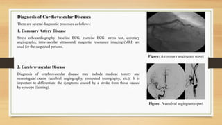 Figure: A coronary angiogram report
Diagnosis of Cardiovascular Diseases
There are several diagnostic processes as follows:
1. Coronary Artery Disease
Stress echocardiography, baseline ECG, exercise ECG- stress test, coronary
angiography, intravascular ultrasound, magnetic resonance imaging (MRI) are
used for the suspected persons.
2. Cerebrovascular Disease
Diagnosis of cerebrovascular disease may include medical history and
neurological exams (cerebral angiography, computed tomography, etc.). It is
important to differentiate the symptoms caused by a stroke from those caused
by syncope (fainting).
Figure: A cerebral angiogram report
 