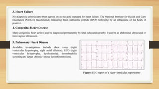 3. Heart Failure
No diagnostic criteria have been agreed on as the gold standard for heart failure. The National Institute for Health and Care
Excellence (NIHCE) recommends measuring brain natriuretic peptide (BNP) following by an ultrasound of the heart, if
positive.
5. Pulmonary Heart Disease
Available investigations include chest x-ray (right
ventricular hypertrophy, right atrial dilation); ECG (right
ventricular hypertrophy, dysrhythmia); thrombophilia
screening (to detect chronic venous thromboembolism).
Figure: ECG report of a right ventricular hypertrophy
4. Congenital Heart Disease
Many congenital heart defects can be diagnosed permanently by fetal echocardiography. It can be an abdominal ultrasound or
transvaginal ultrasound.
 