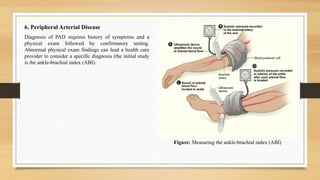 6. Peripheral Arterial Disease
Diagnosis of PAD requires history of symptoms and a
physical exam followed by confirmatory testing.
Abnormal physical exam findings can lead a health care
provider to consider a specific diagnosis (the initial study
is the ankle-brachial index (ABI).
Figure: Measuring the ankle-brachial index (ABI)
 