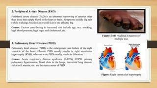 Figure: PAD resulting in necrosis of
multiple toes
2. Peripheral Artery Disease (PAD)
Peripheral artery disease (PAD) is an abnormal narrowing of arteries other
than those that supply blood to the heart or brain. Symptoms include leg pain
(while walking), bluish skin or cold skin in the affected leg.
Causes: Factors contributing to increased risk include age, sex, smoking,
high blood pressure, high sugar and cholesterol, etc.
3. Pulmonary Heart Disease (PHD)
Pulmonary heart disease (PHD) is the enlargement and failure of the right
ventricle of the heart. Chronic PHD usually results in right ventricular
hypertrophy (RVH), whereas acute PHD usually results in dilatation.
Causes: Acute respiratory distress syndrome (ARDS), COPD, primary
pulmonary hypertension, blood clots in the lungs, interstitial lung disease,
sickle cell anemia, etc. are the main causes of PHD.
Figure: Right ventricular hypertrophy
 