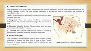 ii. Idiopathic: Idiopathic diseases (Moyamoya) are those that occur
spontaneously without a known reason.
iii. Acquired: The acquired cerebrovascular disease is caused by
atherosclerosis, embolism, aneurysms, and arterial dissections.
Figure: Illustration of a cerebral aneurysm
5. Heart Failure (HF)
Heart failure (HF) is that condition when the heart is unable to pump
sufficiently to maintain the blood flow to meet the body's needs.
Shortness of breath, excessive tiredness, and leg swelling are the
common symptoms.
Causes: The reasons behind the cerebrovascular disease consists of the
following three types:
i. Congenital: These are medical conditions (Arteriovenous
malformations and germinal matrix hemorrhage) that are present at
birth.
4. Cerebrovascular Disease
These are diseases of the blood vessels supplying blood to the brain, including a variety of medical conditions affecting the
cerebral circulation vessels. The most common presentation is an ischemic stroke or mini-stroke, and sometimes a
hemorrhagic stroke.
 