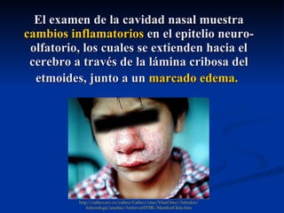 El examen de la cavidad nasal muestra  cambios inflamatorios  en el epitelio neuro-olfatorio, los cuales se extienden hacia el cerebro a través de la lámina cribosa del etmoides, junto a un  marcado edema.   http://caibco.ucv.ve/caibco/Caibco/vitae/VitaeOnce/Articulos/ Infectologia/amebas/ArchivosHTML/ManifestClinic.htm 