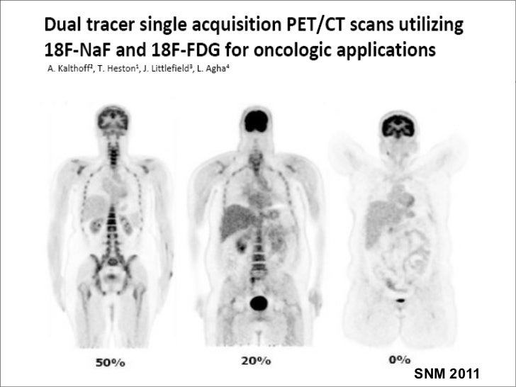 Dual Tracer Single Acquisition Imaging in Nuclear Medicine