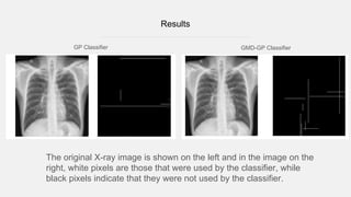 Results
The original X-ray image is shown on the left and in the image on the
right, white pixels are those that were used by the classifier, while
black pixels indicate that they were not used by the classifier.
GP Classifier GMD-GP Classifier
 