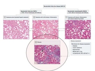 Evidence based management of Non Alcoholic fatty liver disease | PPTX