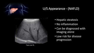 U/S Appearance - (NAFLD)
• Hepatic steatosis
• No inflammation
• Can be diagnosed with
imaging alone
• Low risk for disease
progression
 
