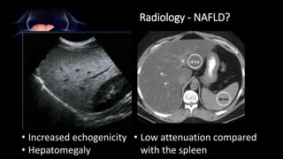 Radiology - NAFLD?
• Increased echogenicity
• Hepatomegaly
• Low attenuation compared
with the spleen
 