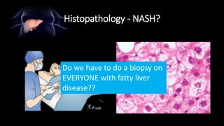 Histopathology - NASH?
• Liver biopsy is the GOLD standard
Do we have to do a biopsy on
EVERYONE with fatty liver
disease??
 