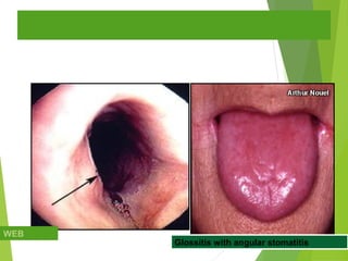 Pathology of the Esophagus | PPT
