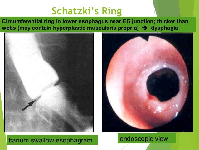 What Is Schatzki Ring In The Esophagus What Is Schatzki Ring In The Esophagus