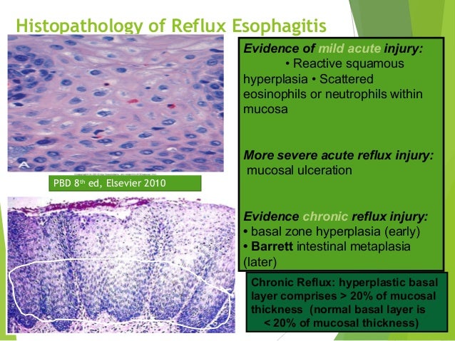 Pathology of the Esophagus