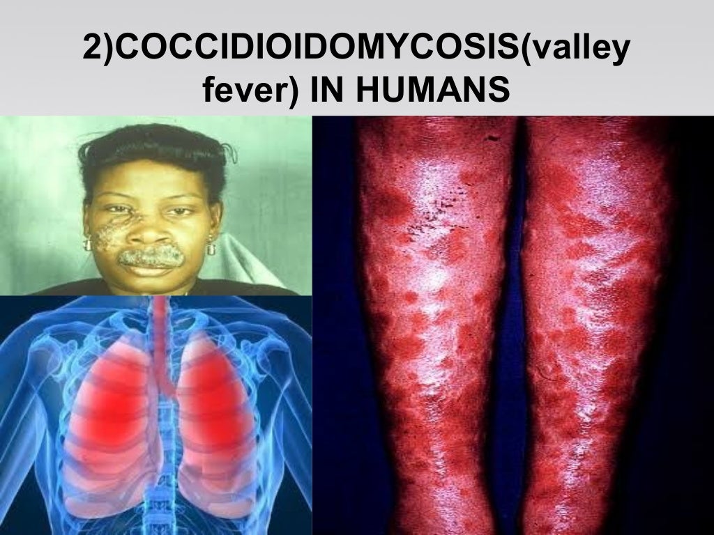 fungal diseases in humans and animals