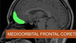 MEDIOORBITAL FRONTAL CORETE
 
