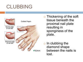 Nail Clubbing Algorithm Nail anatomy and its disorders | PPTX