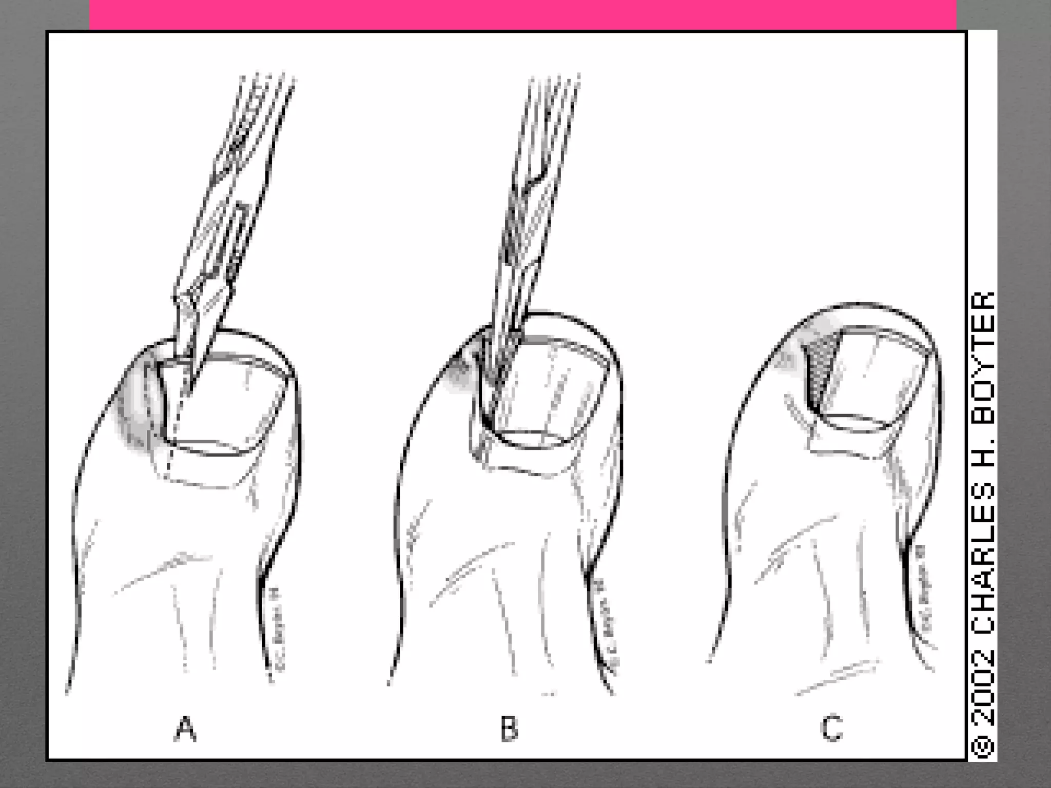 NAIL AVULSION PPT