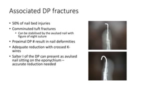 Associated DP fractures
• 50% of nail bed injuries
• Comminuted tuft fractures
• Can be stabilised by the avulsed nail with
figure of eight suture
• Proximal DP # result in nail deformities
• Adequate reduction with crossed K-
wires
• Salter I of the DP can present as avulsed
nail sitting on the eponychium –
accurate reduction needed
 