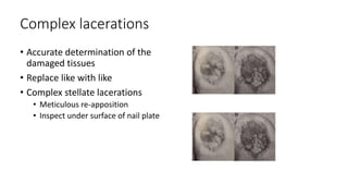 Complex lacerations
• Accurate determination of the
damaged tissues
• Replace like with like
• Complex stellate lacerations
• Meticulous re-apposition
• Inspect under surface of nail plate
 
