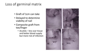 Loss of germinal matrix
• Graft of 1cm can take
• Delayed to determine
viability of nail
• Composite graft from
toe/finger
• Acutely – less scar tissue
and better blood supply
but more risk of infection
 