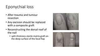 Eponychial loss
• After trauma and tumour
resection
• Any excision should be replaced
with a composite graft
• Reconstructing the dorsal roof of
the nail
• split-thickness sterile matrix graft on
the deep surface of the local flap
 