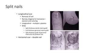 Split nails
• Longitudinal scar
• Removal of nail
• Narrow, diagonal or transverse –
excision and suturing
• Longitudinal – multiple z-plasties
• Wide
• Split thickness sterile matrix graft
• Full thickness germinal matrix graft
• Split thickness graft of germinal
matrix do not produce nail
• Horizontal scar – double nail
 