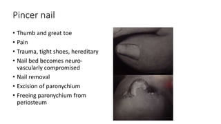 Pincer nail
• Thumb and great toe
• Pain
• Trauma, tight shoes, hereditary
• Nail bed becomes neuro-
vascularly compromised
• Nail removal
• Excision of paronychium
• Freeing paronychium from
periosteum
 