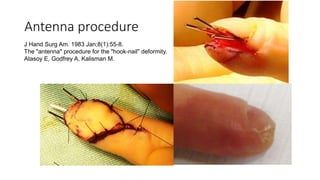 Antenna procedure
J Hand Surg Am. 1983 Jan;8(1):55-8.
The "antenna" procedure for the "hook-nail" deformity.
Atasoy E, Godfrey A, Kalisman M.
 