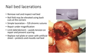 Nail bed lacerations
• Remove nail and inspect nail bed
• Nail fold may be elevated using back
cuts at the corners
• Simple laceration – 7/0 chromic sutures
• Repair under magnification
• Limit debridement – avoids tension on
repair and prevent scarring
• Replace nail plate or cover with artificial
sheet – protects and moulds nail bed
 