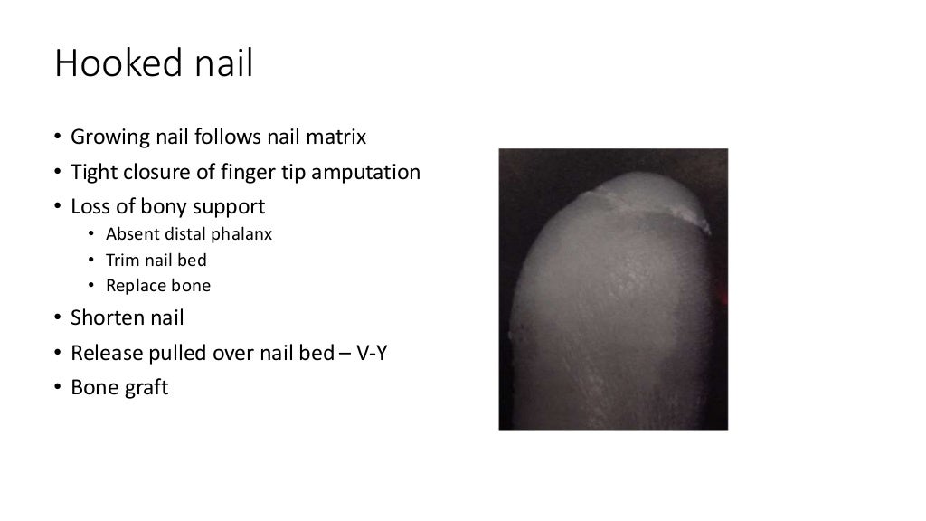 Nail bed injuries
