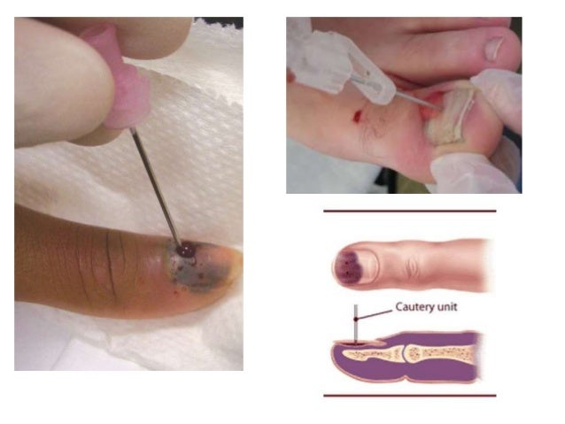 Nail Bed Injury Nail Bed Injury