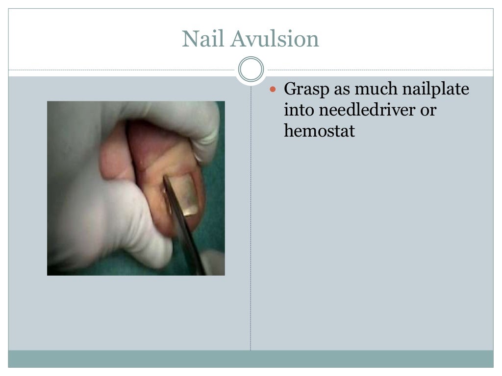 Nail biopsy