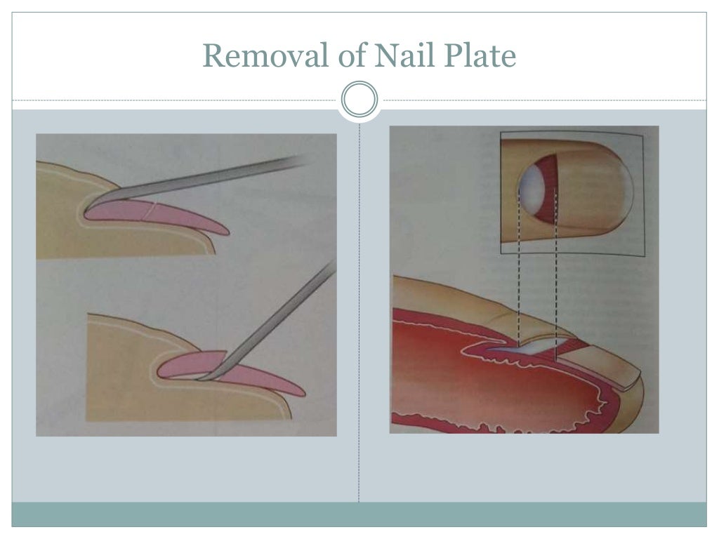 Nail biopsy
