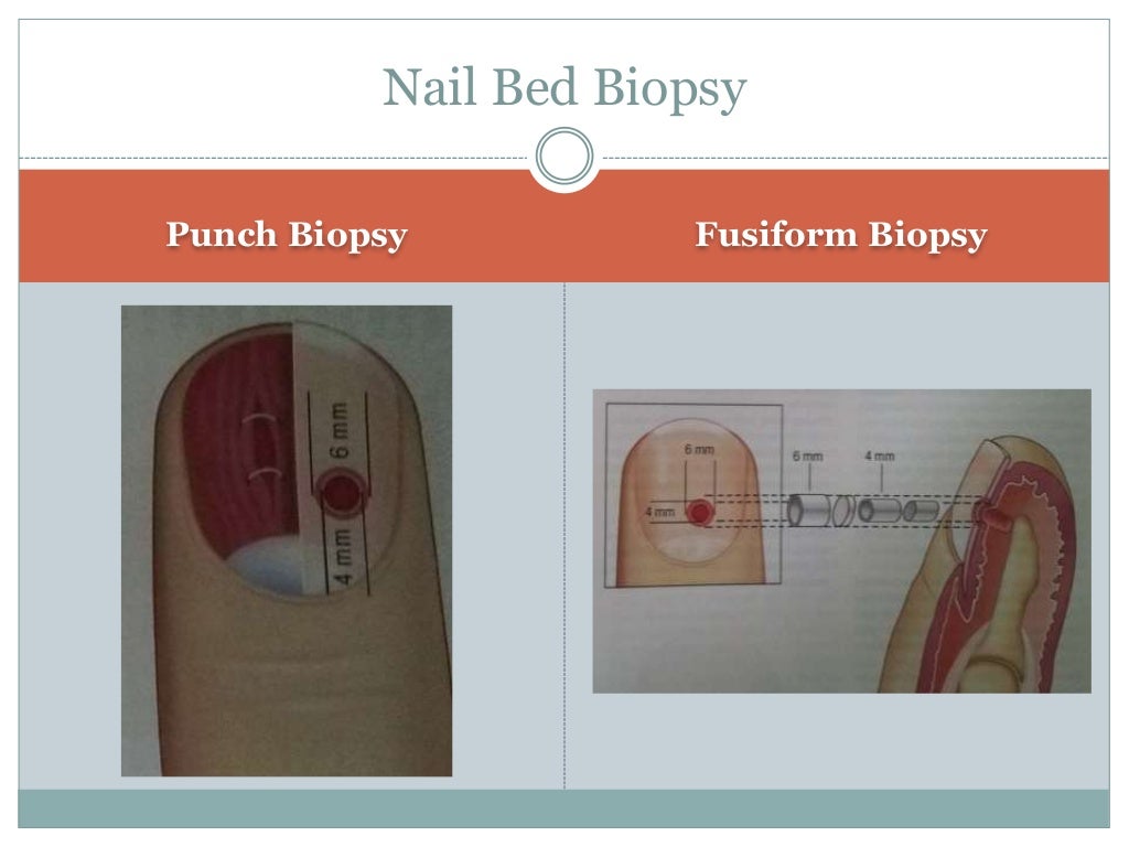 Nail biopsy