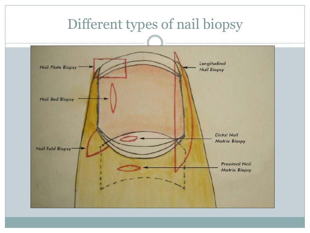 Nail biopsy