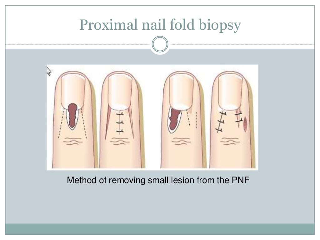 Nail biopsy