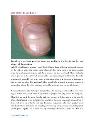 http://www.spasalon.us
Nail Clinic: Beau's Lines
Learn how to recognize transverse ridges, you need know it to how to care for your
clients with this condition.
in 1846 when French physician Joseph Honoré Simon Beau first show horizontal grooves
on the nail, or transverse ridges. Beau’s lines, as they have come to be known, occur
when the nail matrix is injured and the growth of the nail is slowed. This eventually
causes grooves in the surface of the nail plate. concerning finger- and toenails, this state
is commonly caused by an injury such as slamming a finger in the door or dropping a
heavy object on a toe. The horizontal ridges can also be a sign of a systemic disease, a
disease that affects the whole body and not just be an agency or a congenital disease.
Whatever the reason for halting of nail growth or the slowing, it will result in transverse
ridges on the nails, which look like pale bands lying horizontally across the nail plate.
They first appear at the moon (lunula) and then progress with the growth of the nail. In
cases where the ridges are not caused by a systemic illness or congenital disease, Beau’s
lines will grow out with the nail and disappear. Fingernails take approximately nine
months about one millimeter per week to grow out completely, with the middle fingernail
growing most rapidly, and toenails take approximately 18 months to grow out. With this
 