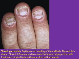 Swollen Cuticles Nail Diseases.pptx hjilsllslslslsllsldke | PPTX