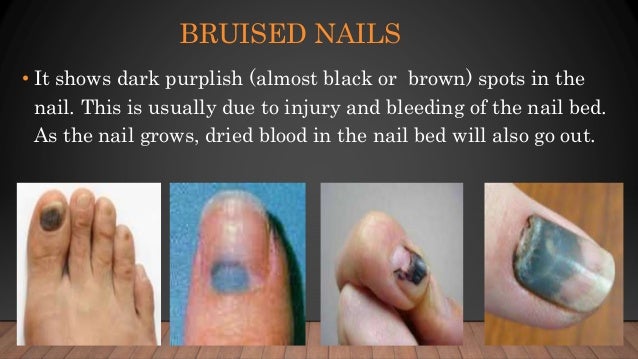 Nail Diseases And Disorders
