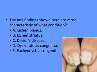 • The nail findings shown here are most
characteristic of what condition?
• A. Lichen planus.
• B. Lichen striatus.
• C. Darier’s disease.
• D. Dyskeratosis congenita.
• E. Pachyonychia congenita.
 