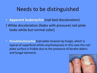 Needs to be distinguished
• Apparent leukonychia (nail bed discoloration)
( White discoloration (fades with pressure) nail plate
looks white but normal color)
• Pseudoleukonychia (nail plate invasion by fungi), which is
typical of superficial white onychomycosis In this case the nail
plate surface is friable due to the presence of keratin debris
and fungal elements
 
