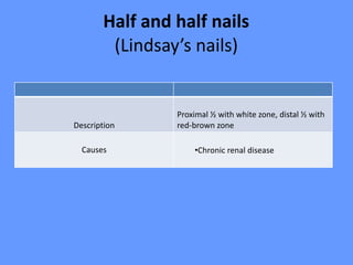 Half and half nails
(Lindsay’s nails)
Proximal ½ with white zone, distal ½ with
red-brown zoneDescription
•Chronic renal diseaseCauses
 