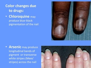 Color changes due
to drugs:
• Chloroquine may
produce blue-black
pigmentation of the nail
• Arsenic may produce
longitudinal bands of
pigment or transverse
white stripes (Mees'
stripes) across the nail
 