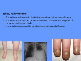 Yellow nail syndrome
• The nails are yellow due to thickening, sometimes with a tinge of green
• The lunula is obscured and there is increased transverse and longitudinal
curvature and loss of cuticle
• It is usually accompanied by lymphoedema and pleural effusions
 