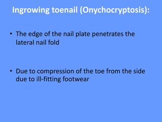 Ingrowing toenail (Onychocryptosis):
• The edge of the nail plate penetrates the
lateral nail fold
• Due to compression of the toe from the side
due to ill-fitting footwear
 