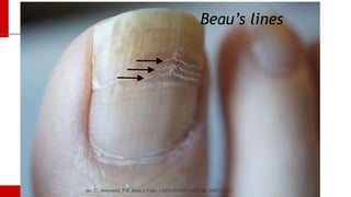 Nail Disorders Dr.mahar almorish dermatology.pptx