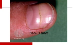 Nail Disorders Dr.mahar almorish dermatology.pptx
