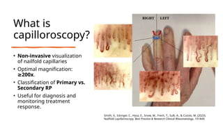 Nailfold Capillary Changes and Pulmonary hypertension | PPTX