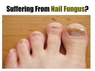 Suffering From  Nail Fungus ? 