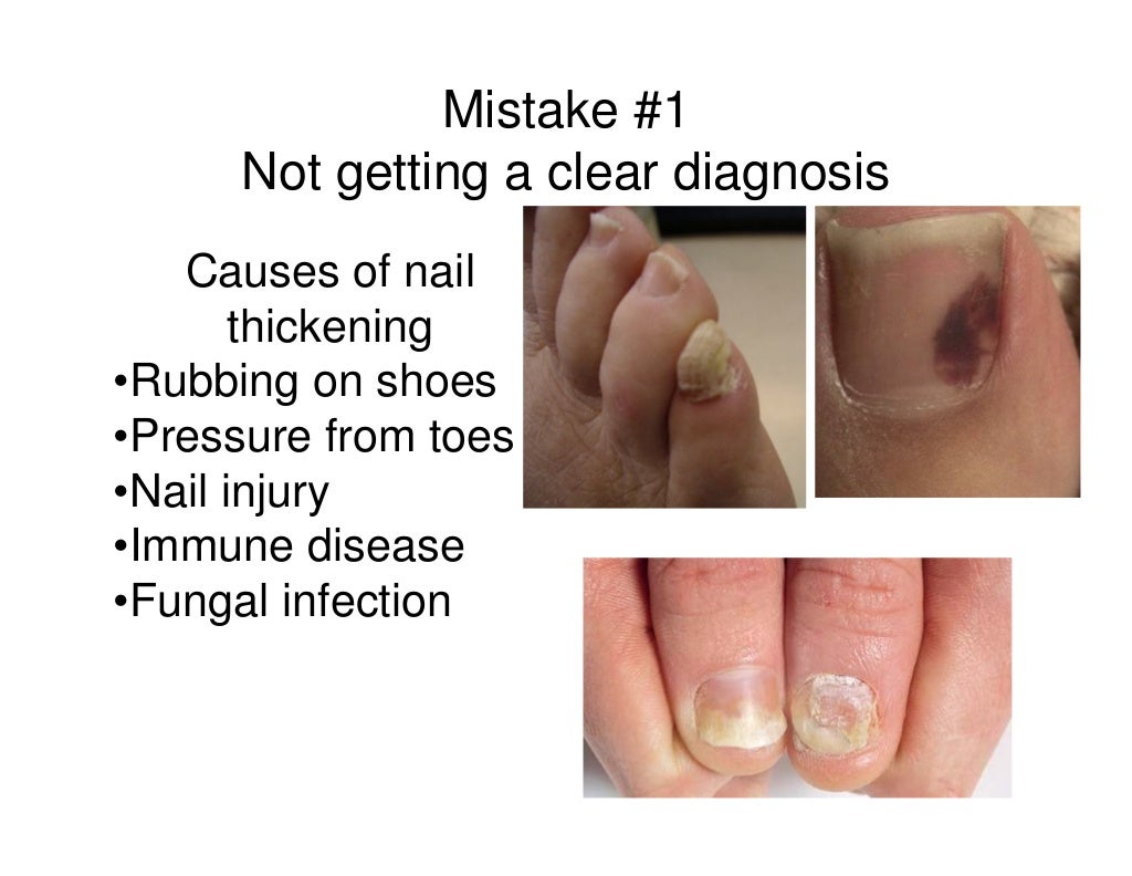 Healthcare Guide To Laser Treatment For Toenail Fungus